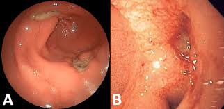 Stomach Cancer Treatment in Electronic City